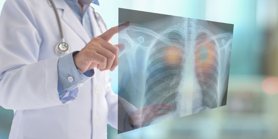 Lung Cancer in Non-Smokers